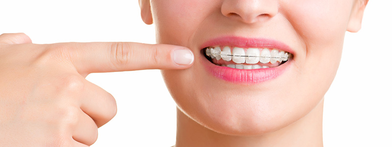 Need for Orthodontic Treatment