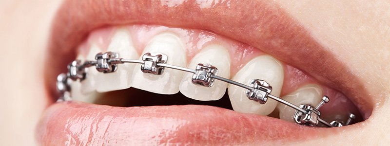 Ortodontik Tedavi Nedir?