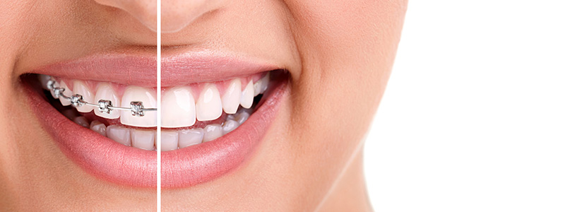 Orthodontic Treatment Methods